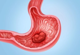 胃出血严重吗后果是什么引起的南阳东大肛肠医院 “糜烂性胃炎”严重吗？