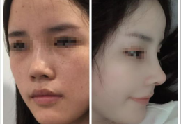 鼻骨整形,重塑面部轮廓，焕发自信风采